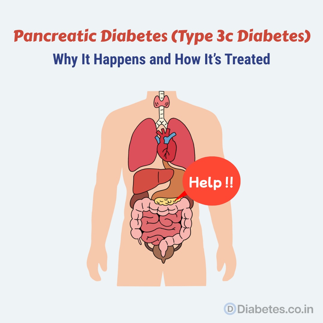 Pancreatic Diabetes (Type 3c Diabetes)